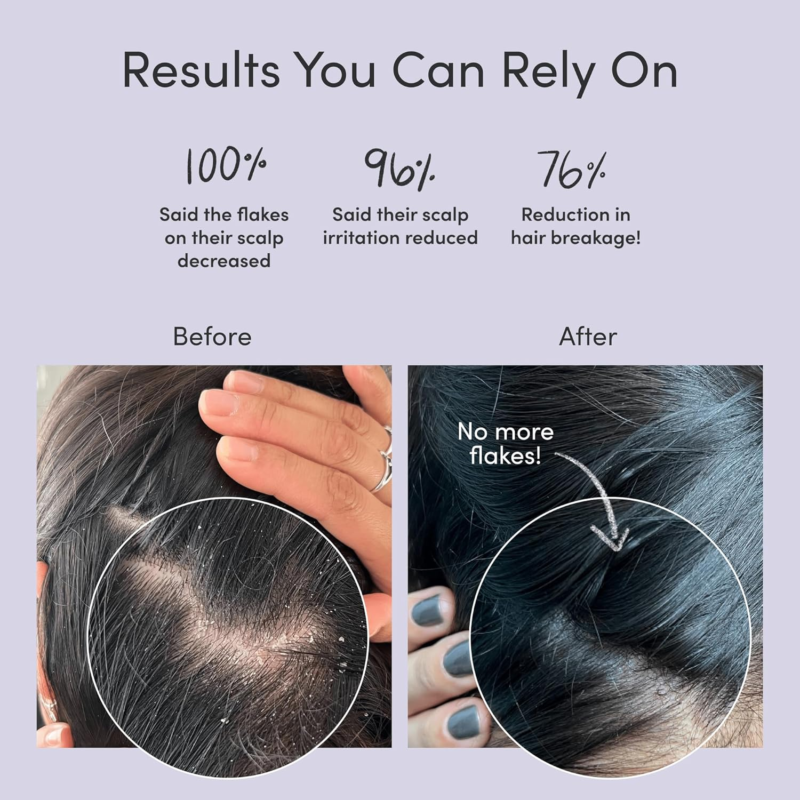 JUPITER Formulated Anti-Dandruff Shampoo & Conditioner, for Flaky, Itchy, Oily, Dry Scalp - Image 2