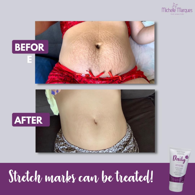 Stretch Mark Cream Soften and Provides Hydration - Image 5