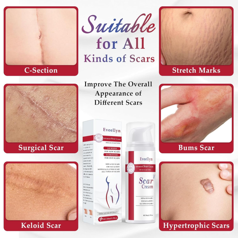 Advanced Stretch Mark, Keloid Bump, C-Section & Scar Removal Cream - Image 2