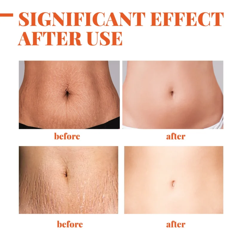 Stretch Marks Remover Essential Oil - Image 3