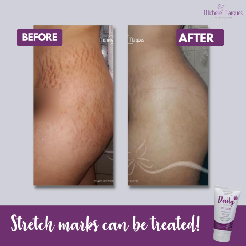 Stretch Mark Cream Soften and Provides Hydration - Image 4